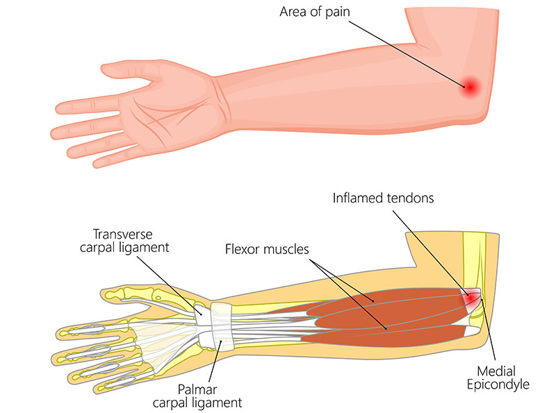 Medial Epikondilit (Golfçü Dirseği)