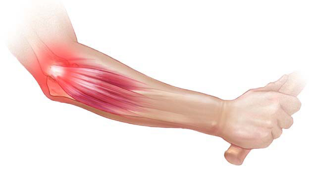 Lateral Epikondilit (Tenisçi Dirseği)