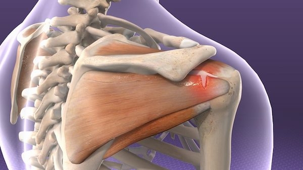 Rotator Cuff Sendromu